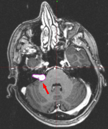 MRI image showing an acoustic neuroma