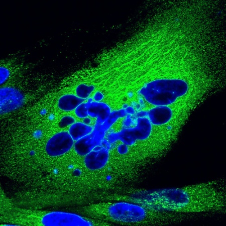 Human fibroblast undergoing nuclear fragmentation in a late stage of apoptosis. The nucleus is stained in blue and the cytoplasm in green. Photomicrograph by Joerg Schroeer.